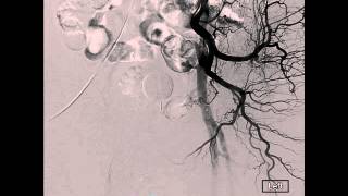 Prostate Artery Embolization Left Internal Iliac Run [upl. by Hartley638]