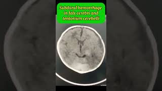 Intracranial bleeding  subdural haemorrhage  SAH  Subarachnoid haemorrhage [upl. by Araeit933]