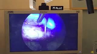 Thoracic duct ligation of chylothorax in shiba inu Karl Storz NIRICG Fluorescence imaging [upl. by Norward869]