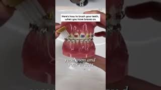 Heres the best technique to keep your teeth sparkling clean with braces on braces dentist [upl. by Tirb]