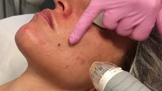 The Vivace Experience – Microneedling with RF energy [upl. by Alba]