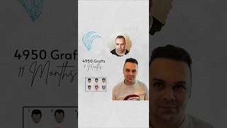 youtubeshorts aesthetic implant hairtransplant trasplantecapilar transplantacijakose dhi [upl. by Yenaffit256]