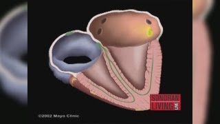 The Mayo Clinic explains how to treat Atrial Fibrillation [upl. by Fayina638]