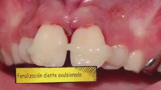 Avulsion dental en diente permanente [upl. by Eynenihc]