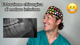 Estrazione chirurgica di dente del giudizio inferiore  i 3 segreti che devi sapere [upl. by Nywroc]