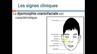 Maladies chromosomiques Pr Ag BELARBI [upl. by Ailes]