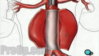 Abdominal Aortic Aneurysm  Open Repair PreOp® Patient Engagement and Education [upl. by Oiuqise787]