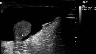 Communicating hydrocele on ultrasound scan [upl. by Becket]