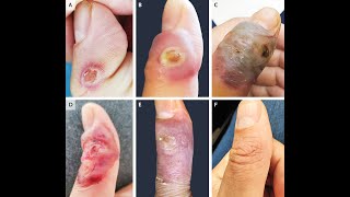 Ecthyma contagiosum durch Schafpockenvirus Orf [upl. by Nac971]