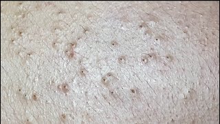 Squeezing blackheads for Khoa P1 HoangMySpa85 [upl. by Iatnahs]