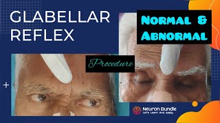 Glabellar Reflex  Myerson’s Sign reflexpathway cranialnerves positiveprimitivereflex neurology [upl. by Yuh]