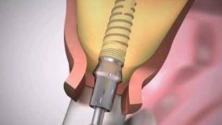 Dental Implants Procedure  Simplified [upl. by Kip]