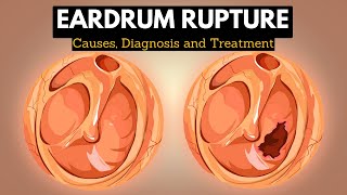 The Science Behind Eardrum Rupture Explained in Simple Terms [upl. by Egres]