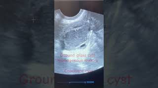 Endometriosis infertilityChochlate ovary cyst treatmenttrendingshorts viralsongendometriosisivf [upl. by Annahsohs190]