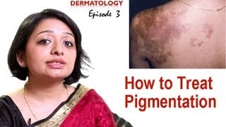 How to Treat Skin Pigmentation Episode 3 [upl. by Nwahshar532]