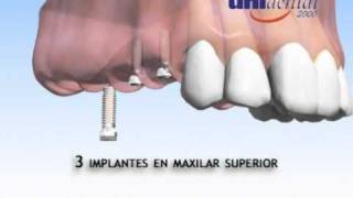 Implantes Dentales Clínicas Dentales Unidental [upl. by Adnim404]