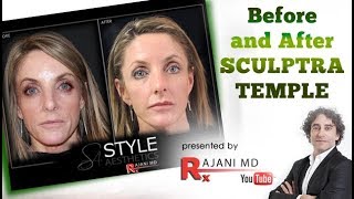 Watch Sculptra Injected Temples  Before and After Sculptra [upl. by Lema]