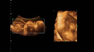 Omphalocele by 4D ultrasound [upl. by Teplitz]