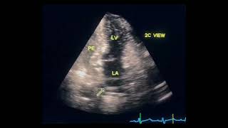 Pericardial effusion and LA collapse to drahmadmirdamadisiC1IXQDQrHgkAYk2Z [upl. by Eciruam91]