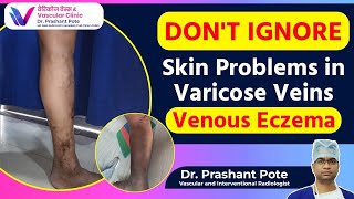 Dont Ignore These Symptoms Venous Eczema amp Varicose Veins Explained  Dr Prashant Pote [upl. by Octavius1]