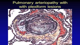 Pulmonary Hypertension Pathology [upl. by Aramas]