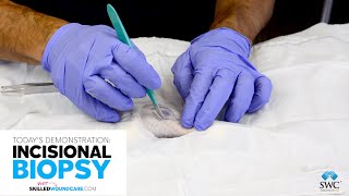 Incisional Biopsy Demo  Skilled Wound Care [upl. by Ayatal483]