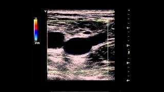 Limited Examination of The Lower Extremity Venous System for DVT [upl. by Nylzor]