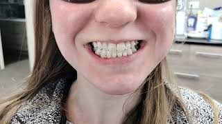 SureSmile Clear Aligners with rubber bands to correct the bite and align the teeth [upl. by Ben771]