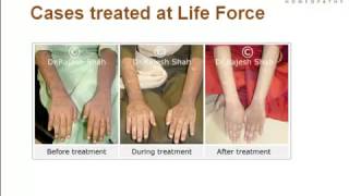 What is Lichen Planus Presentation By Experts at Life Force [upl. by Neidhardt]