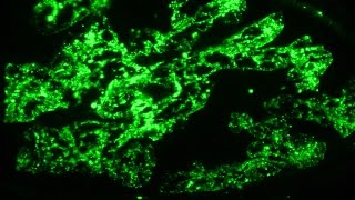 Nephritic syndrome and post infectious glomerulonephritis  Pathology mini tutorial [upl. by Zeuqram]