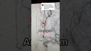 Cerebral Angiogram [upl. by Almeda]