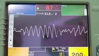 Taquicardia Ventricular Polimorfica 🤯🤯 [upl. by Bazluke]