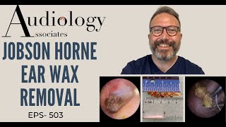 JOBSON HORNE EAR WAX REMOVAL  EP 503 [upl. by Carmencita]