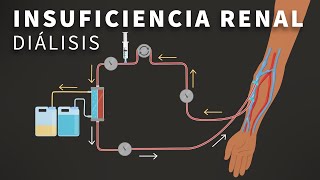 Insuficiencia Renal Terminal y Dialisis [upl. by Gnemgnok704]