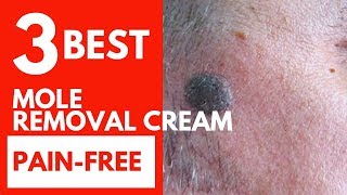 Top 3 Best mole removal creamSurgical Alternative and painfree [upl. by Kilk]