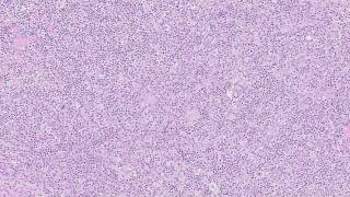 Nodular Sclerosis Hodgkin Lymphoma [upl. by Llednar386]