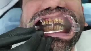 Teeth stain removal with Airflow [upl. by Annayad]