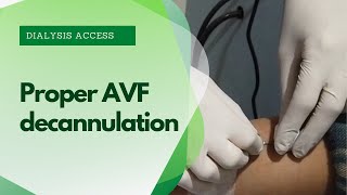 AVF Decannulation procedure  avf cannulation techniques [upl. by Midan]