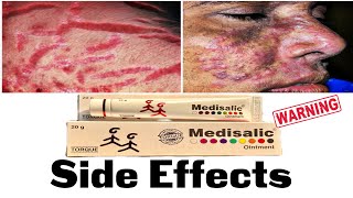 Medisalic Cream Side effects How to use medisalic cream [upl. by Hobart]