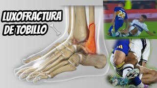 LUXOFRACTURA DE TOBILLO futbol fractura [upl. by Moscow]