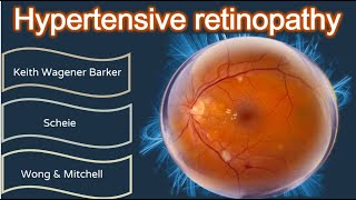 Hypertensive retinopathy simplified [upl. by Annazus]