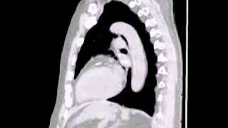 Lytic lesions in multiple myeloma lower res [upl. by Portwin]