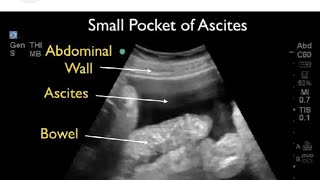 Ultrasound video showing Ascites ascites medicalmasti  ultrasoundvideoascites medicalmasti [upl. by Fredrika]