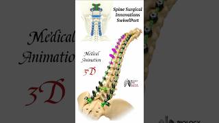 Spine Surgical Innovations SwivelPort medical animation 3d short  BiologywithAliya [upl. by Kathrine]