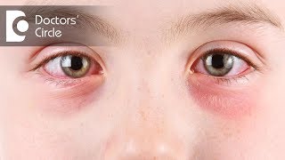 Symptoms of eye allergies  Dr Sriram Ramalingam [upl. by Nala]