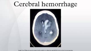 Cerebral hemorrhage [upl. by Pasquale746]