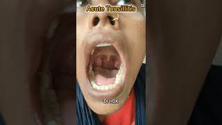 tonsillitis tonsils neetmotivation ent [upl. by Silecara458]