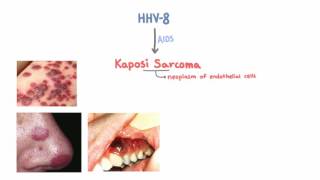 HHV8 and Kaposi Sarcoma [upl. by Riccardo]