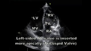 cc TGA how to diagnose by echocardiography [upl. by Nedaj]