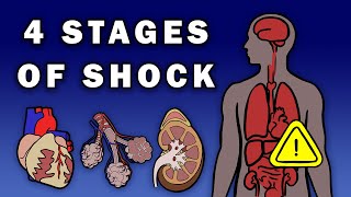 THE 4 STAGES OF SHOCK [upl. by Waldron]